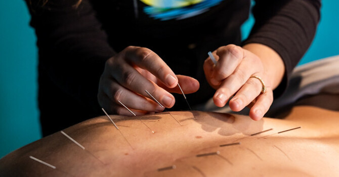 Acupuncture